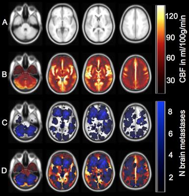 Inverse Perfusion Requirements of Supra- and Infratentorial Brain Metastases Formation